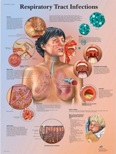 Respiratory Tract Infections Chart VR1253