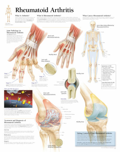 Rheumatoid Arthritis 1152 1