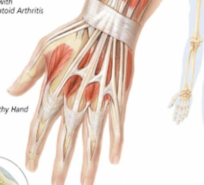 Rheumatoid Arthritis 1152 2