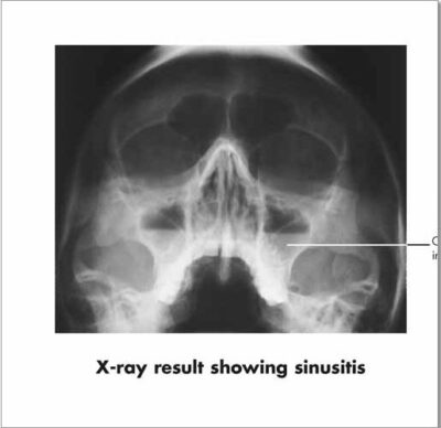 Rhinitis and Sinusitis Chart VR1251 2