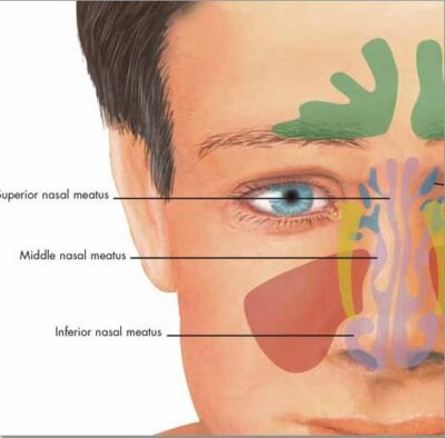 Rhinitis and Sinusitis Chart VR1251 1