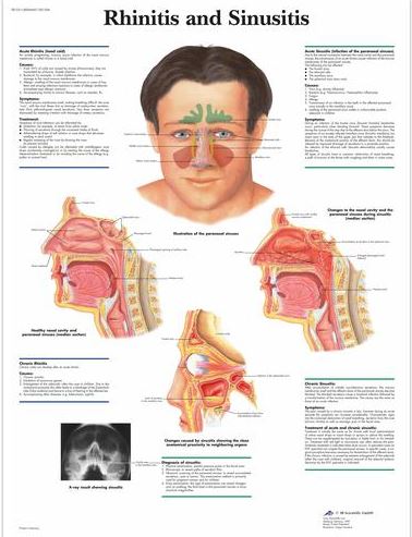 Rhinitis and Sinusitis Chart VR1251