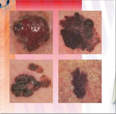 Skin Cancer Chart VR1295 1