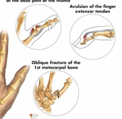 Sports Injuries Chart VR1188 2