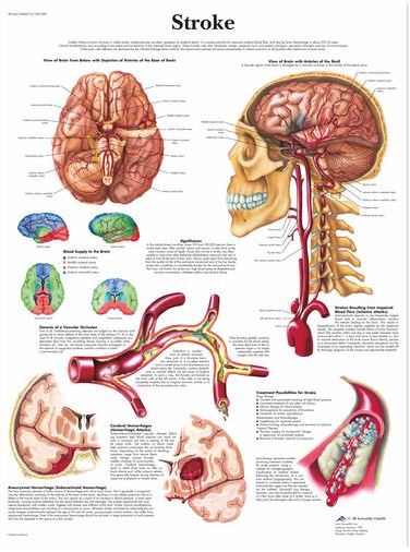 Stroke Chart VR1627