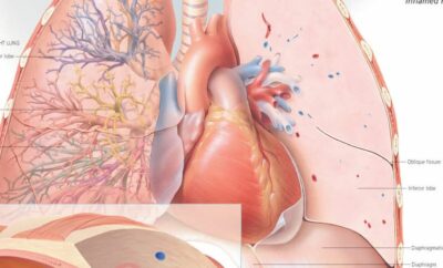 The Common Cold vs. the Flu 1356 3