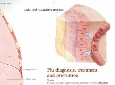 The Common Cold vs. the Flu 1356 2