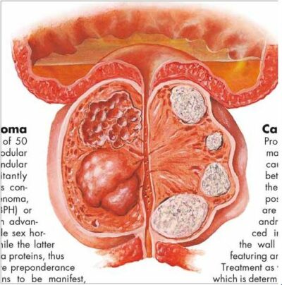 The Prostate Gland chart VR1528 1