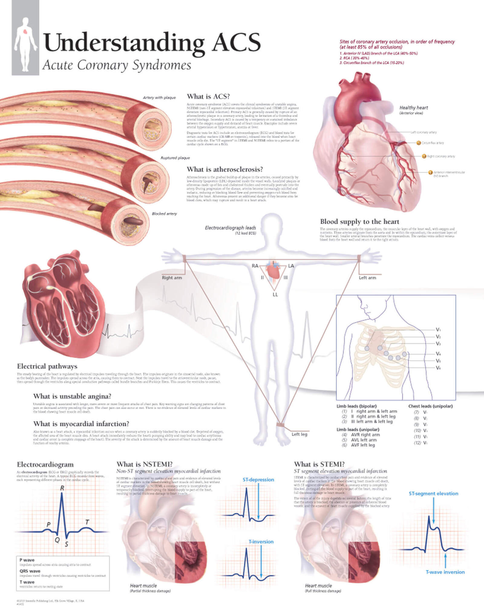 Understanding ACS 1452