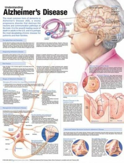 Understanding Alzheimer’s Disease Anatomical Chart 9976 1