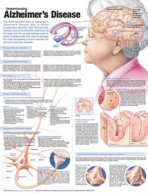 Understanding Alzheimer’s Disease Anatomical Chart 9976