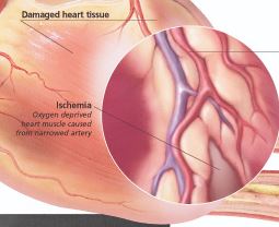 Understanding Angina 1453 3