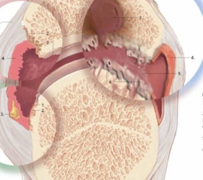 Understanding Arthritis 1052 3