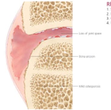 Understanding Arthritis 1052 2