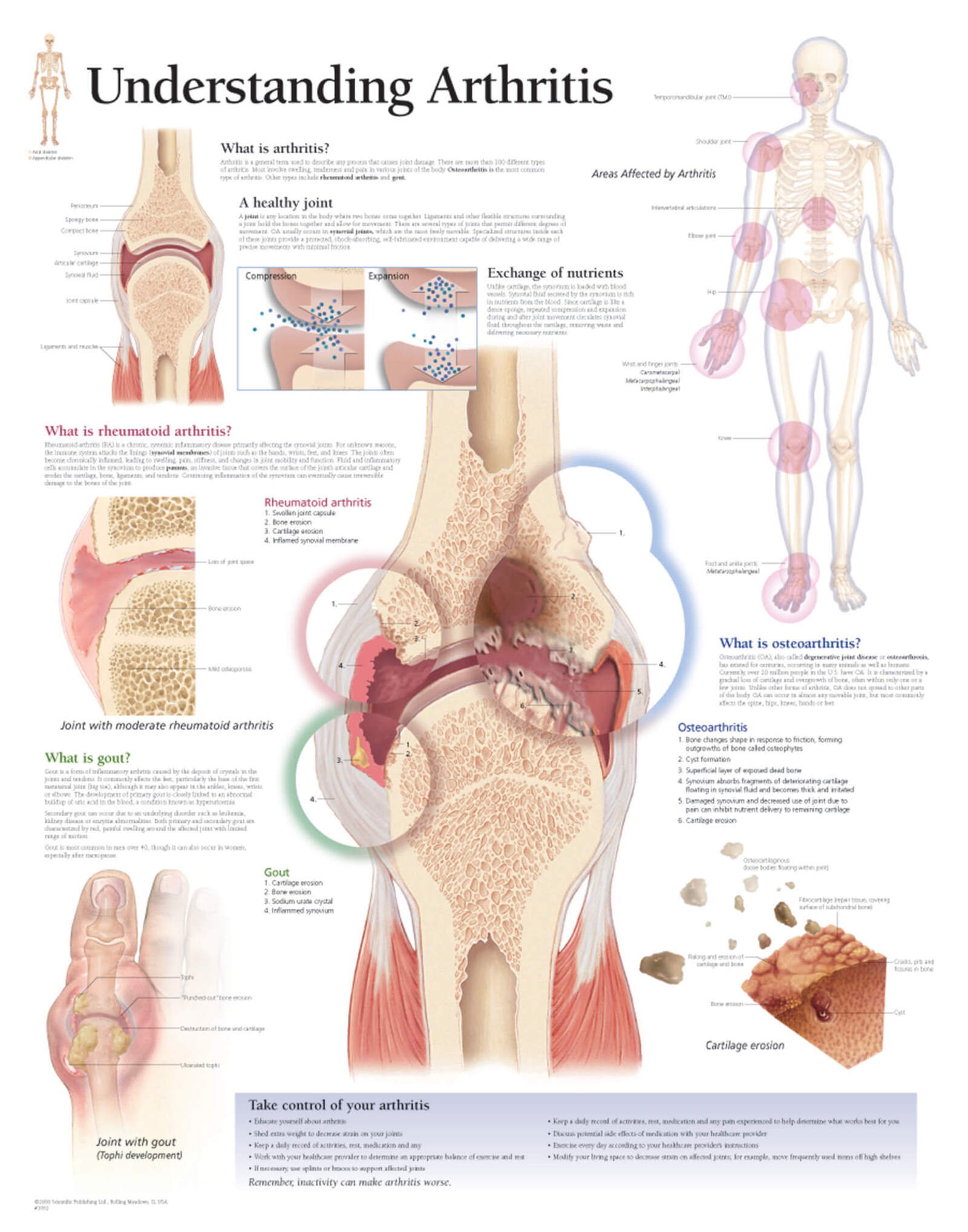 Understanding Arthritis 1052