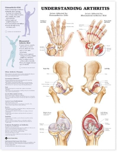Understanding Arthritis Anatomical Chart 9803 1