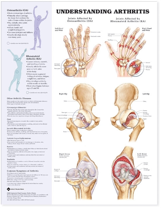 Understanding Arthritis Anatomical Chart 9803