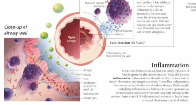Understanding Asthma 1350 3