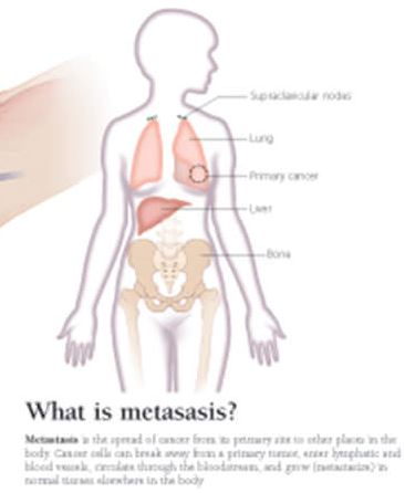 Understanding Breast Cancer 5501 2