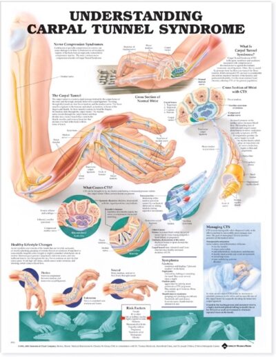 Understanding Carpal Tunnel Syndrome Anatomical Chart 9791 1