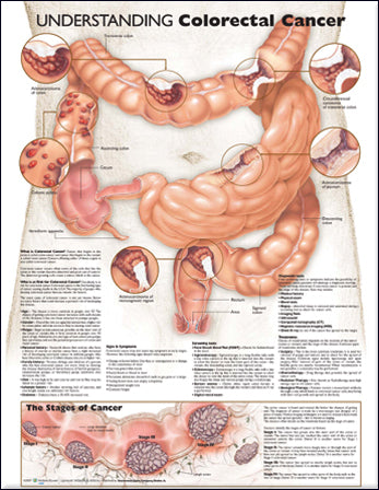Understanding Colorectal Cancer