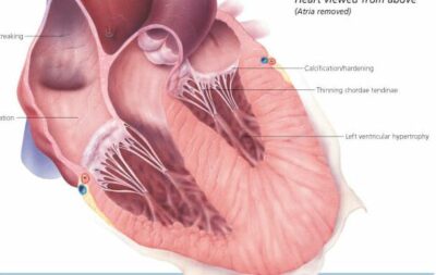 Understanding Heart Disease 1454 2