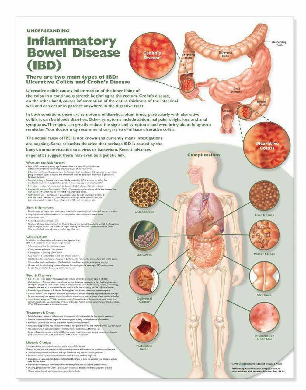 Understanding Inflammatory Bowel Disease