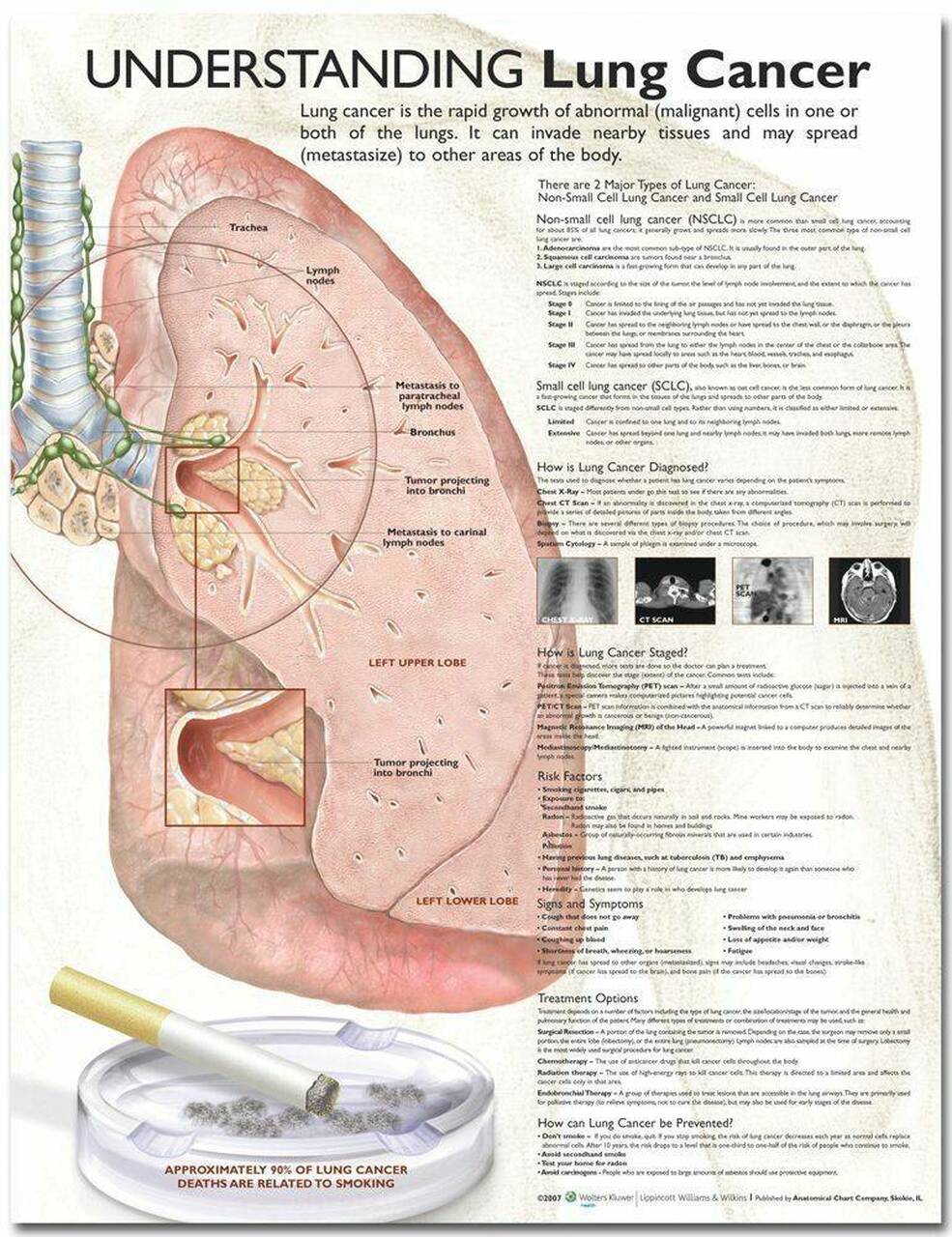 Understanding Lung Cancer