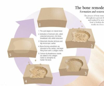 Understanding Osteoporosis 1153 3