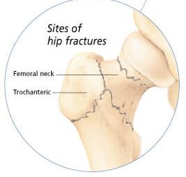 Understanding Osteoporosis 1153 2
