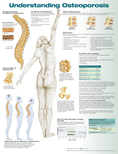 Understanding Osteoporosis 9881 1