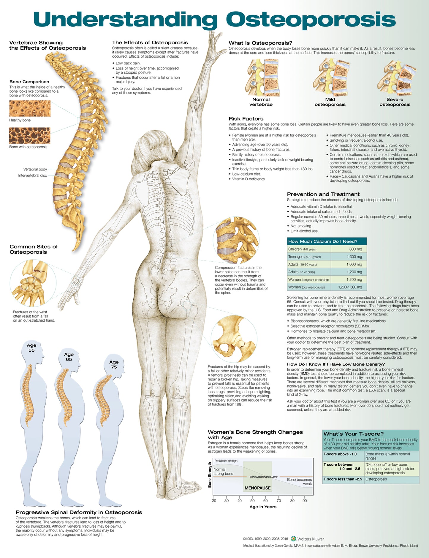 Understanding Osteoporosis 9881
