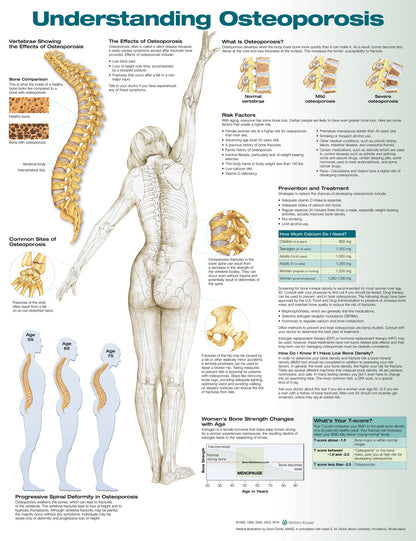 Understanding Osteoporosis 9881