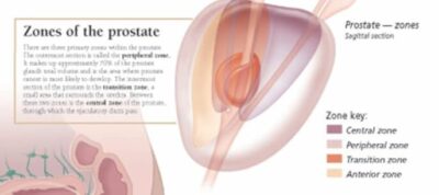 Understanding Prostate Cancer 4501 3