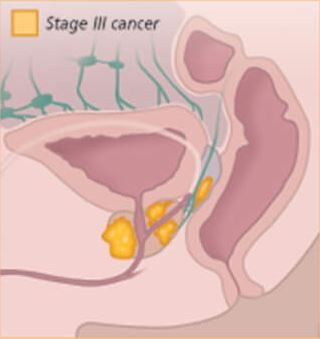 Understanding Prostate Cancer 4501 2