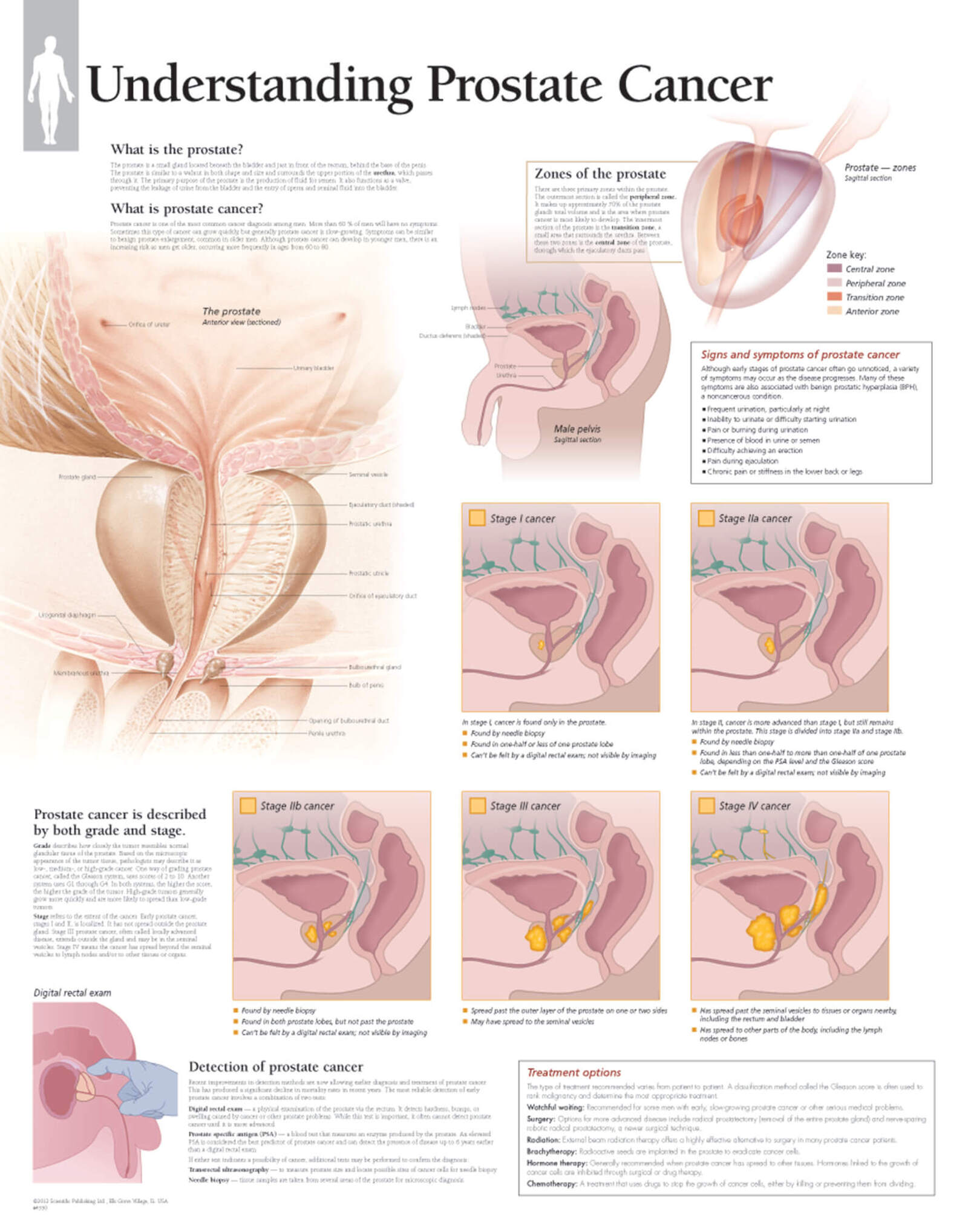 Understanding Prostate Cancer 4501