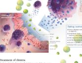 Understanding Rhinitis 1353 2