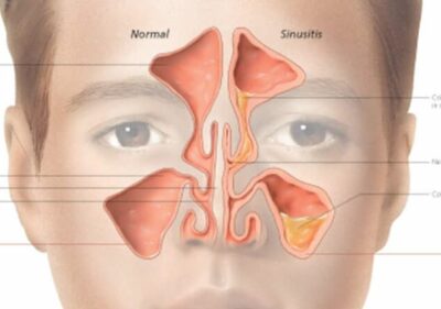 Understanding Sinusitis  1358 3