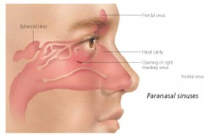 Understanding Sinusitis  1358 2