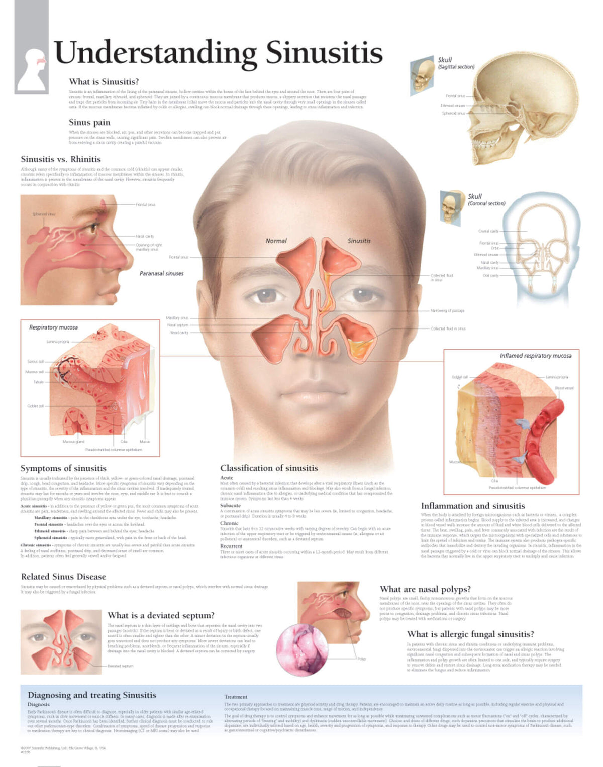 Understanding Sinusitis  1358