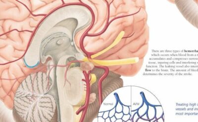 Understanding Stroke 1455 3