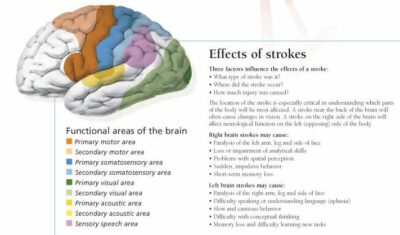 Understanding Stroke 1455 2