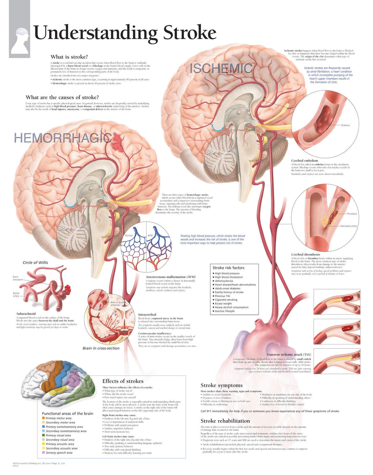 Understanding Stroke 1455
