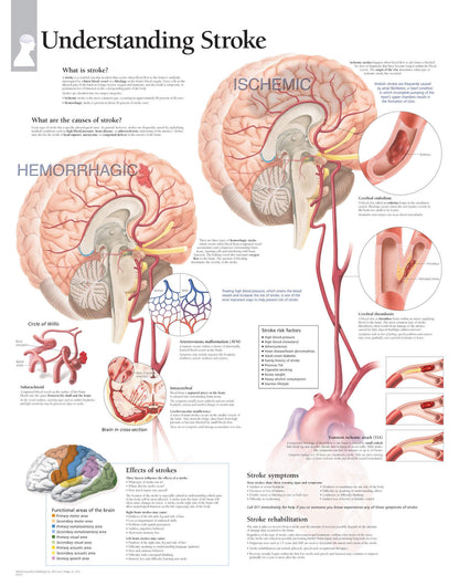 Understanding Stroke 1455