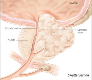 Understanding the Prostate 4500 2