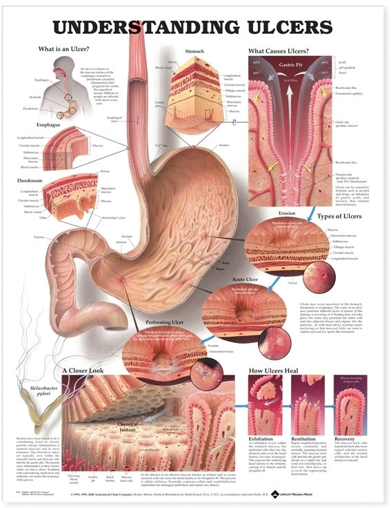 Understanding Ulcers Anatomical Chart 9731