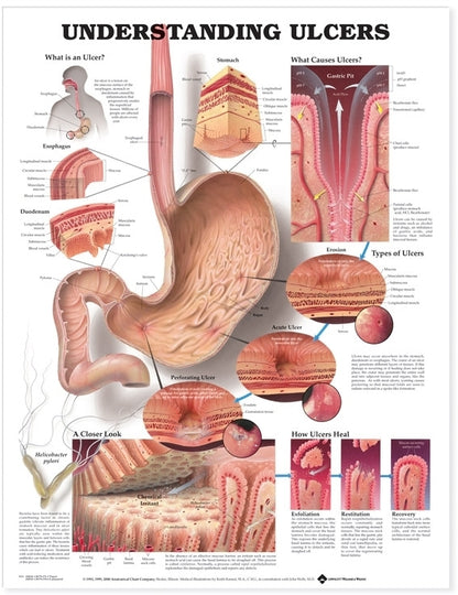 Understanding Ulcers Anatomical Chart 9731