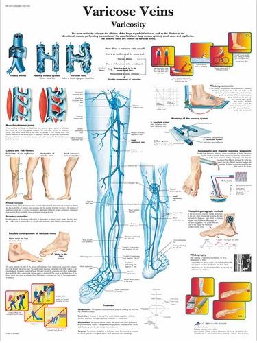 Varicose Veins Chart VR1367