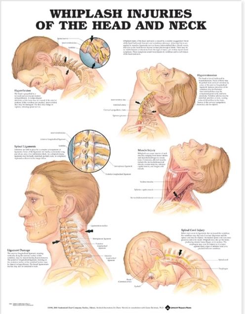 Whiplash Injuries of the Head and Neck Anatomical Chart 9989