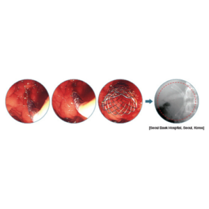 Niti-S Biliary Stent Uncovered